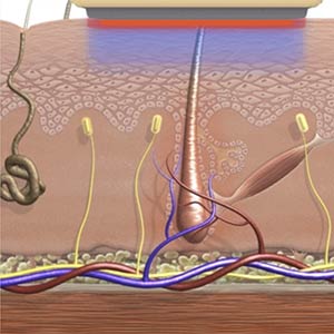 Funktion dauerhafte Haarentfernung, Praxis Dermatologie Hamburg, Steinkraus Skin