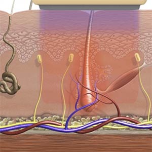 Funktion dauerhafte Haarentfernung, Praxis Dermatologie Hamburg, Steinkraus Skin